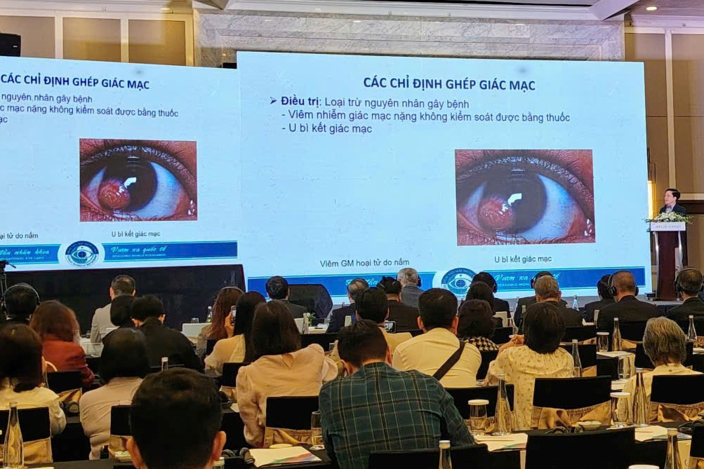 Giác mạc sinh học mang đến cơ hội bảo tồn đôi mắt cho hàng trăm ngàn người bệnh
