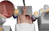 Robot phẫu thuật tí hon sẽ thay đổi phương pháp điều trị ung thư?
