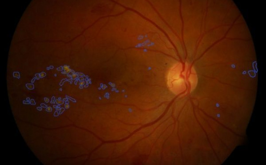 Ứng dụng công nghệ AI vào chẩn đoán bệnh liên quan đến tiểu đường