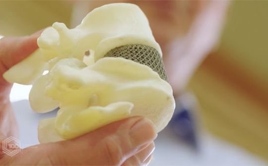 Lần đầu tiên in và cấy ghép thành công đĩa đệm cột sống 3D tại Úc