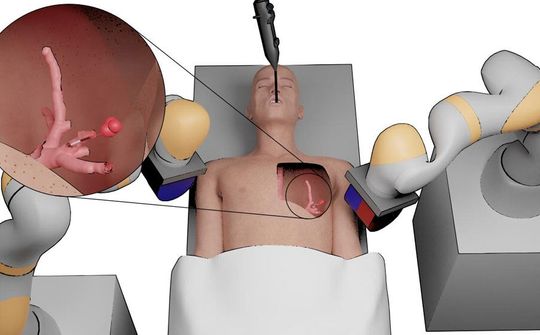 Robot phẫu thuật tí hon sẽ thay đổi phương pháp điều trị ung thư?